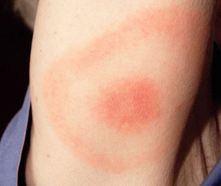 Καλοκαιρινός Συναγερμός για τη Νόσο του Lyme στο Κεμπέκ